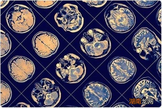 长期睡眠不足的大脑有多“脏”？